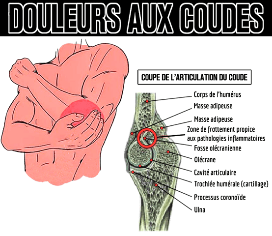 dips et blessure aux coudes